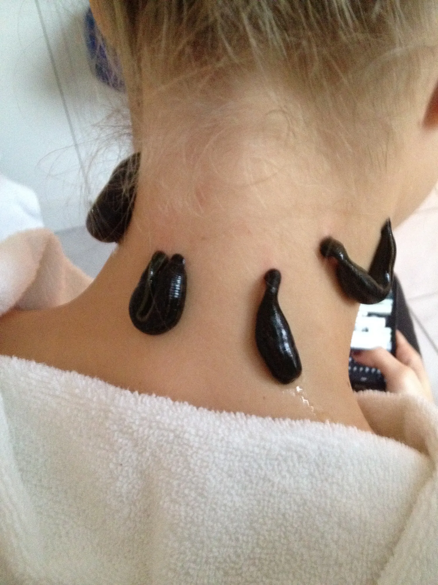 Blutegeltherapie